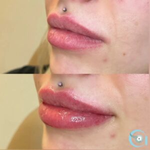 Lip Filler Before & After | Advanced Aesthetics