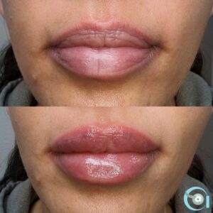 Lip Filler Before and After | Advanced Aesthetics