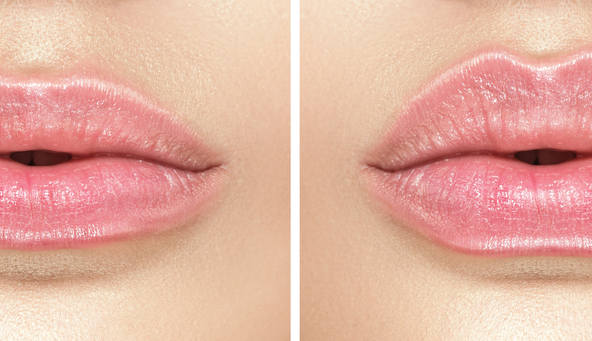 Lip Fillers | Advanced Aesthetics