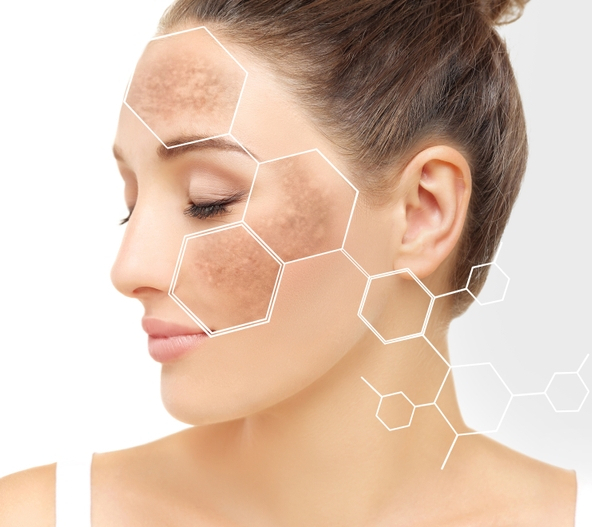 Hyperpigmentation | Advanced Aesthetics