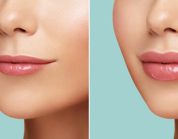 Lip Fillers | Advanced Aesthetics